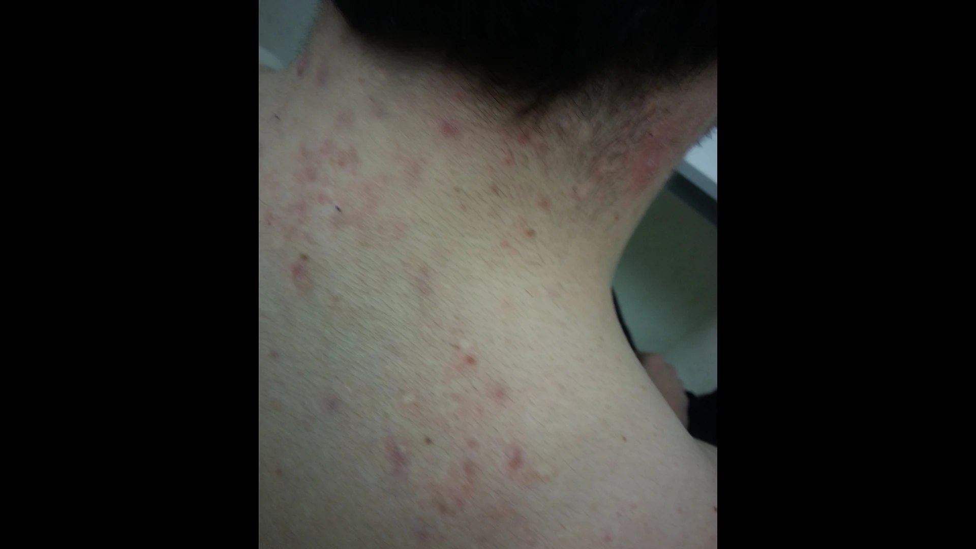 Acne 2